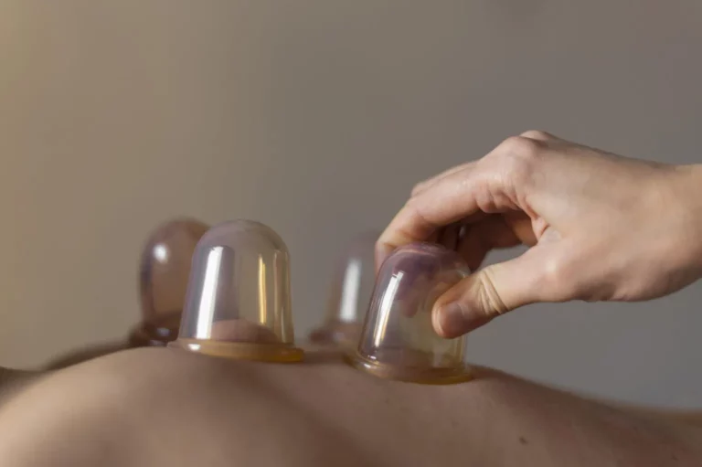 Discover the Healing Power of TCM Cupping in Singapore